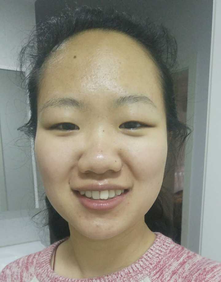 没有鼻梁 大鼻头 肉鼻子 加上眉眼也不好看,内双但是完全看不出 额头