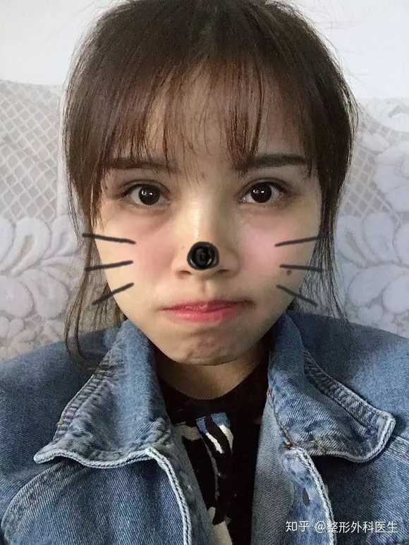 双眼皮形状该怎么选择?