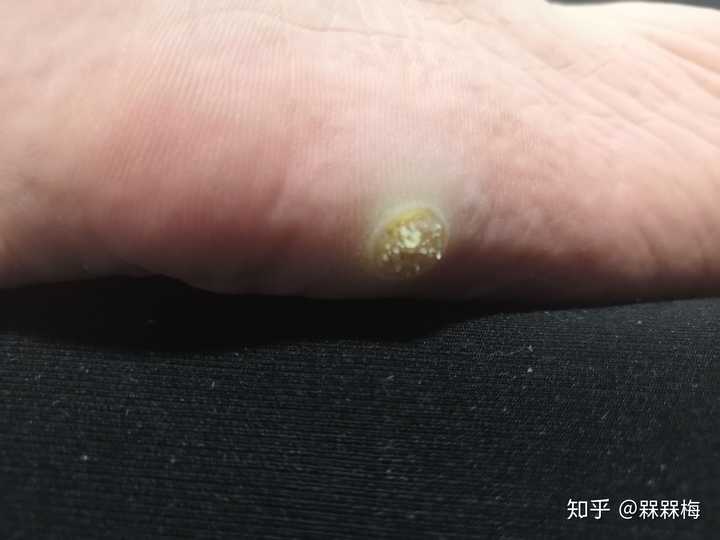 怎么样才能治好?