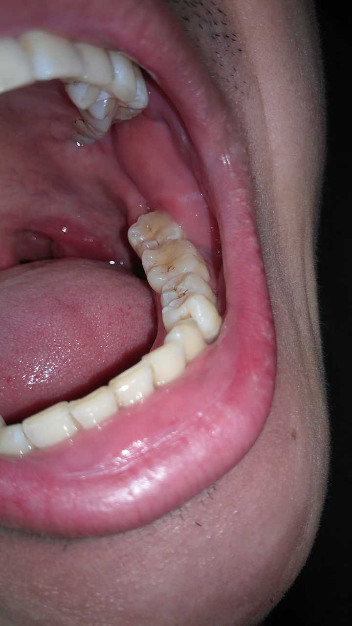 齿位也正,不是传说中的各种阻生齿,长了好些年才长出来,但是因为智齿