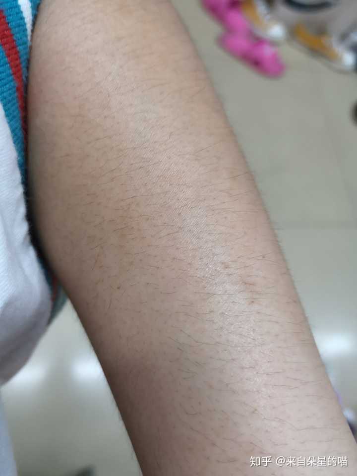 我也不知道为啥,之前没过敏,可能是因为我只用了脱毛膏,没用那个抑制