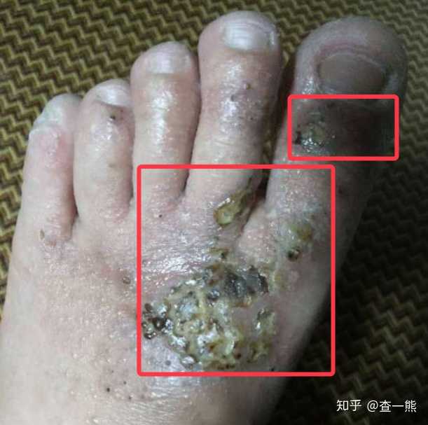 烦人的脚气,请问该怎么治,麻烦给位大神给我一个解决方案?