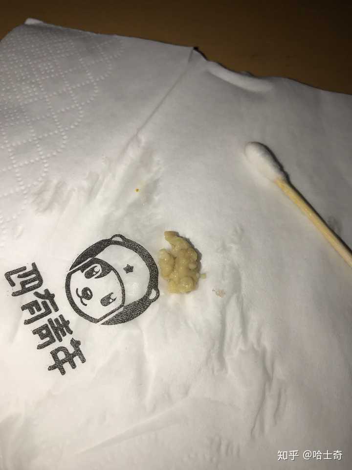 你见过最大的扁桃体结石有多大?