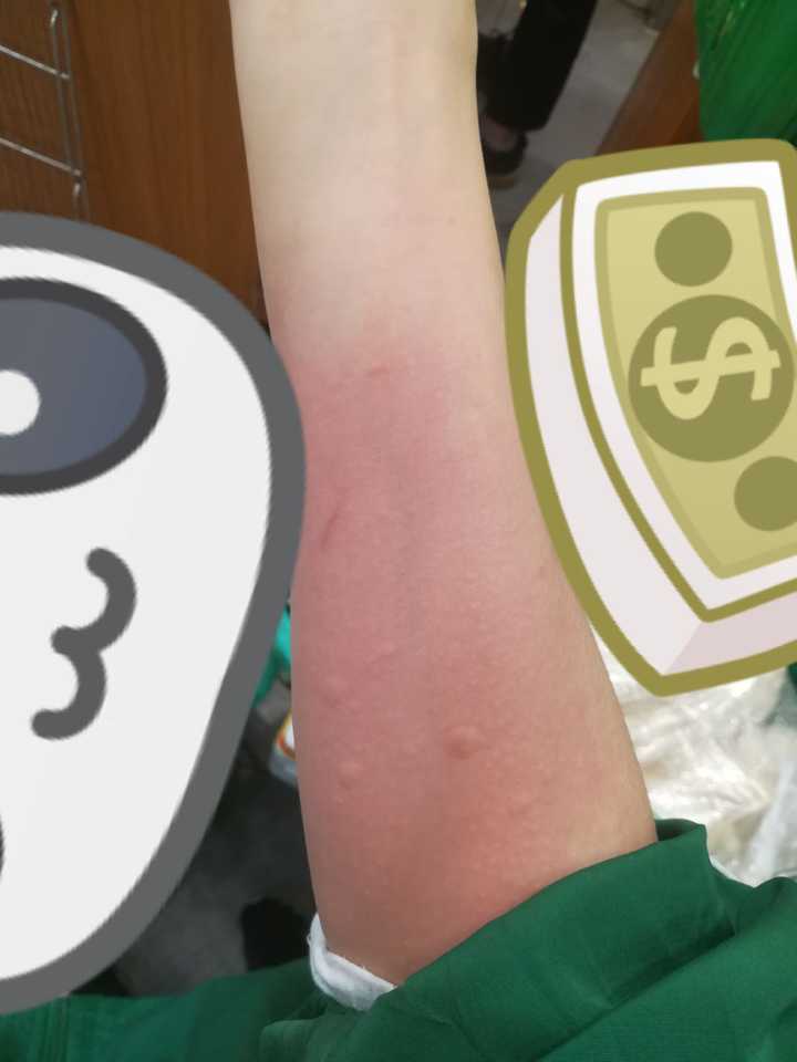 我就想问问,那些冬天有寒冷性荨麻疹的小伙伴是怎么过