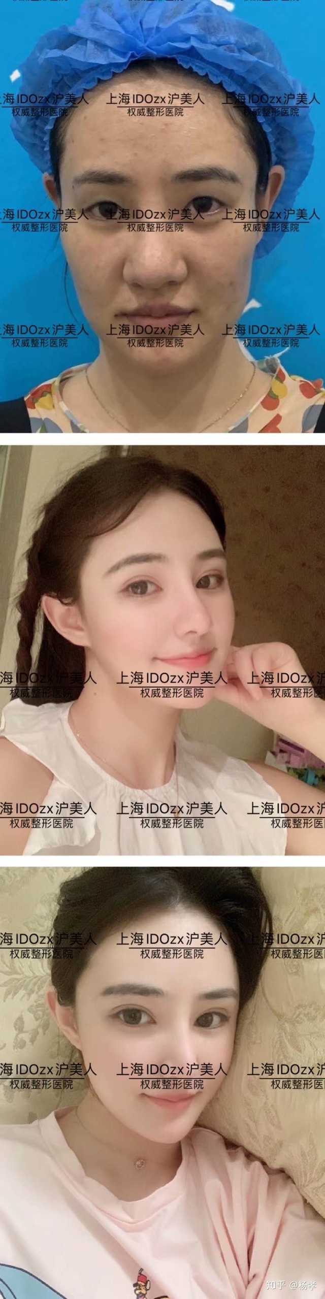 做一个鼻小综合即可,鼻头缩小,假体隆鼻,下面给你我做的案例看一下