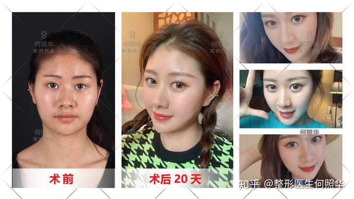 即常见的包含 颧骨高, 颧弓外扩, 下颌角肥大等等,建议选择 改脸型