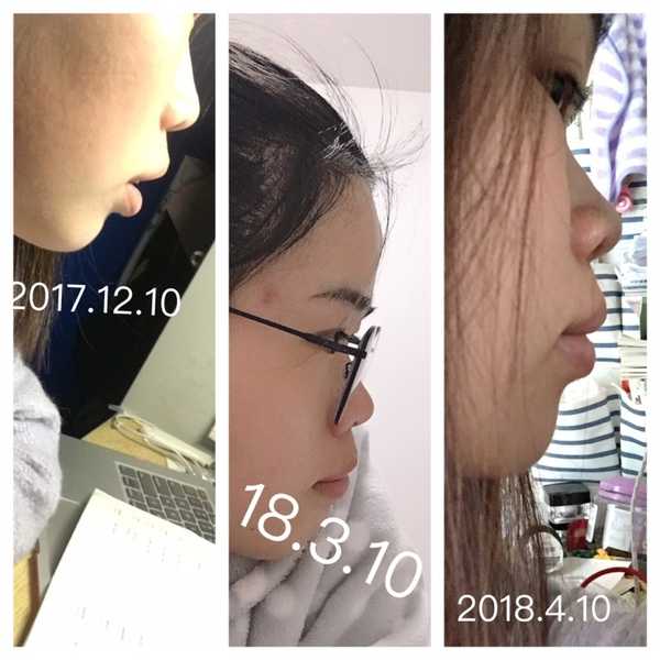 女生矫正牙齿后变美是怎样的感受?