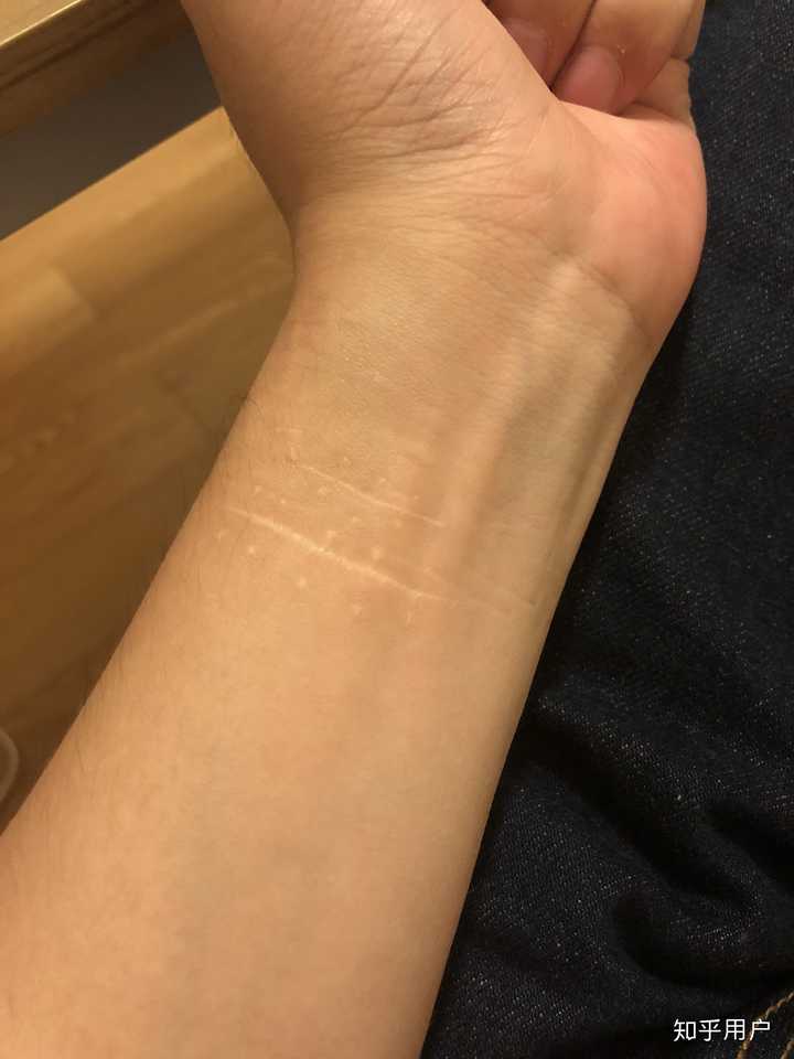 如何向朋友解释自残后的伤疤?