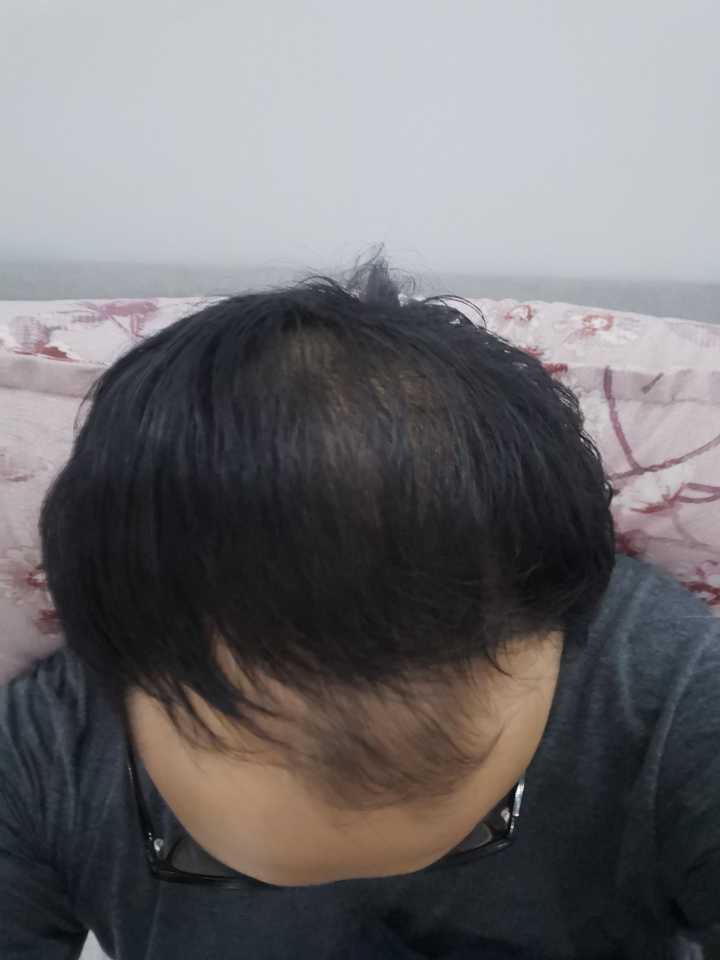 这样算是秃顶吗 19岁?