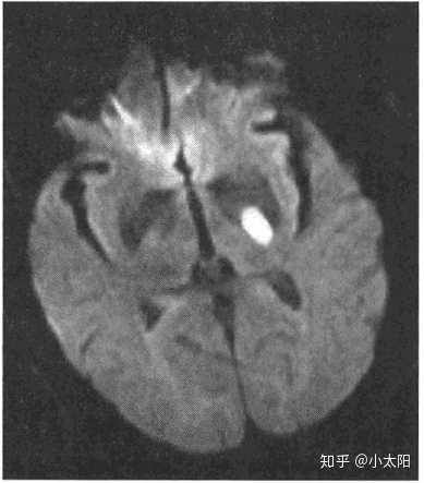 加权成像)显像,在症状出现数分钟内就可发现缺血灶并可早期确定大小