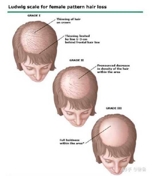女性雄激素性脱发等级图