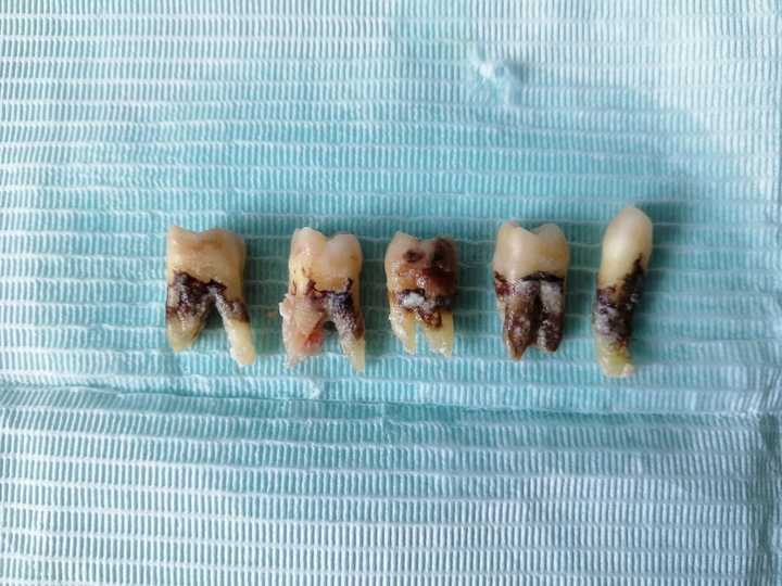 牙医碰见最烂的牙有多烂?