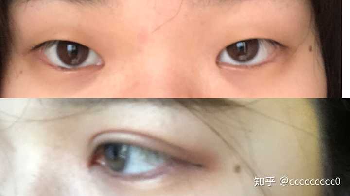 单眼皮变双眼皮真的能使人变好看吗?