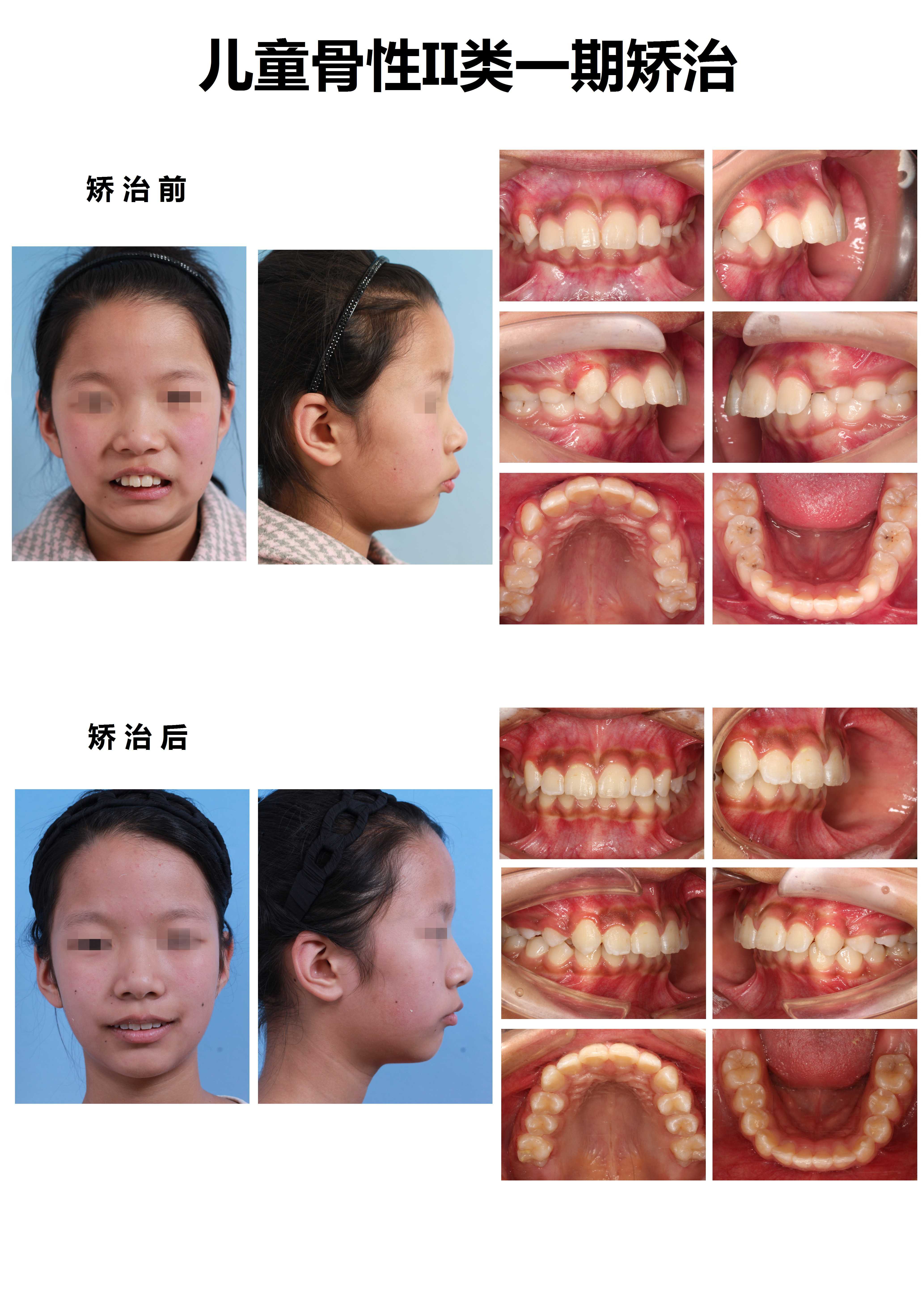 什么情况下需要早期正畸干预?