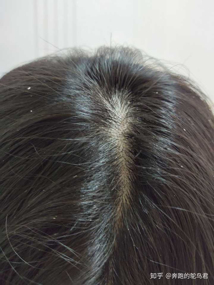 女生秃顶是怎样一种体验?