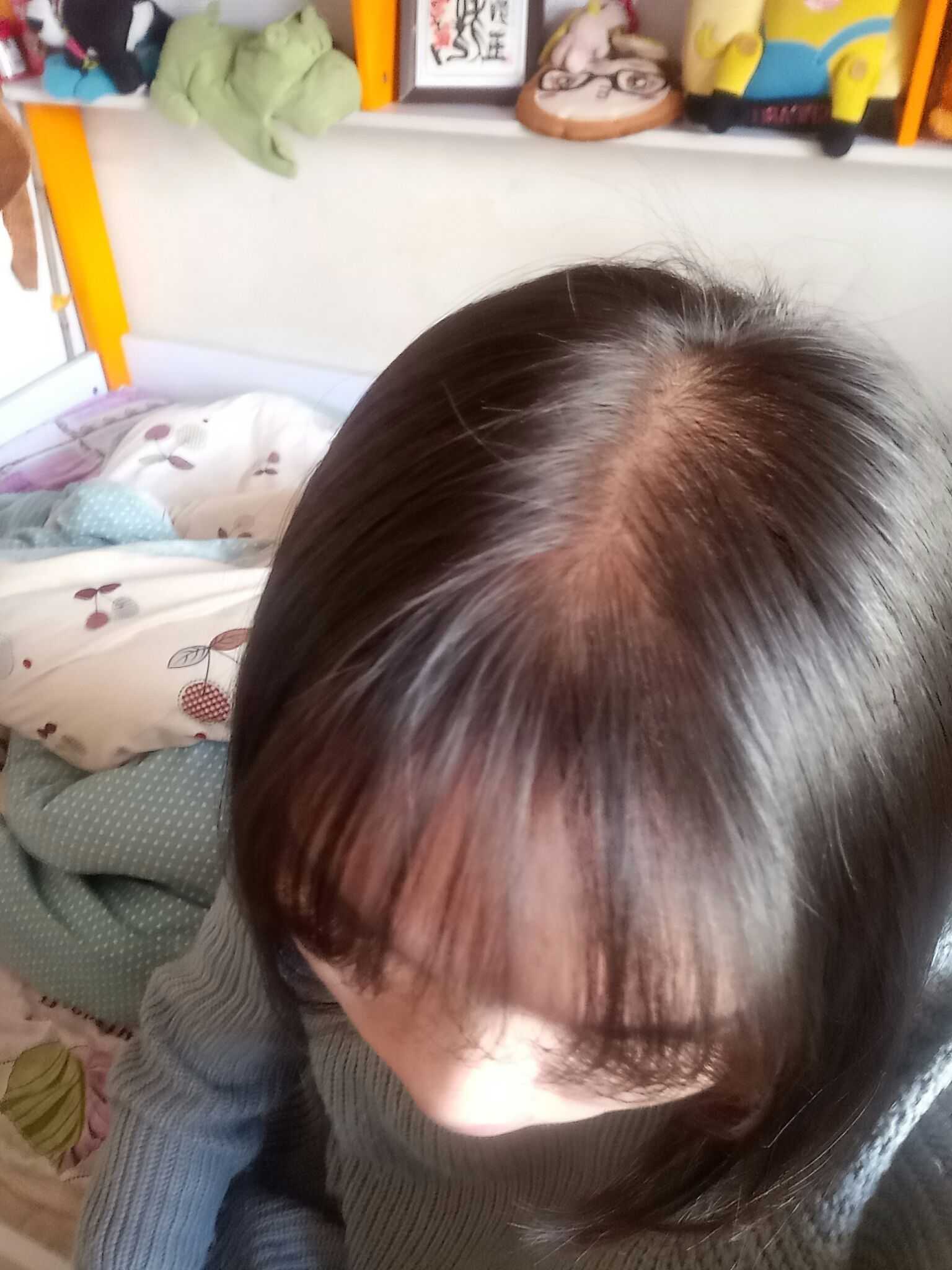 脱发