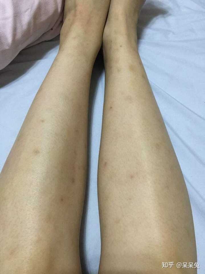 楼主我跟你一样呢,我也是蚊子叮咬的疤痕基本上都在腿上保留下来了,像