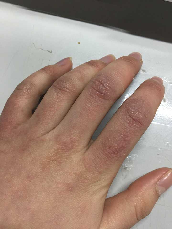 目前手上已经没水泡了.期待天气变暖!