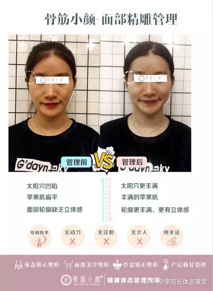 长期的单侧咀嚼啊,托腮等不良习惯会造成咬肌增大,形成大脸