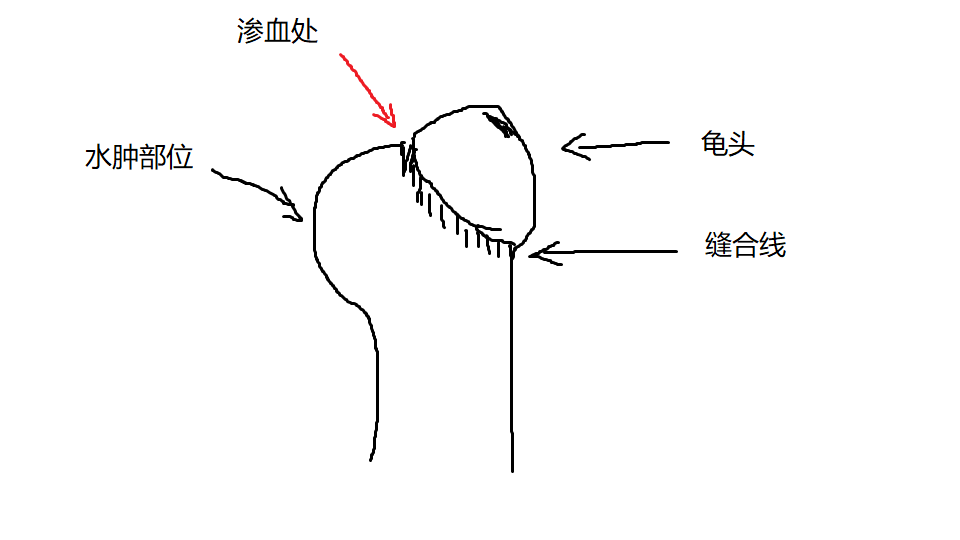 7:00坐下来观察了一下:如医生所说,出现了水肿,这是正常现象,捏龟头