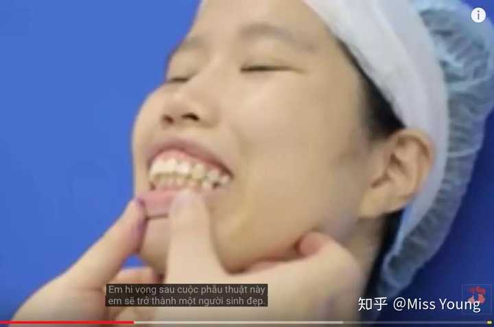 上牙齿是完美的垂直状,那上颌应该是骨相的嘴凸,而下颌则是向前和向下