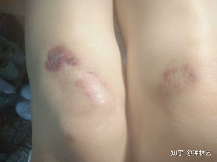 骑车摔伤后,膝盖留疤了.