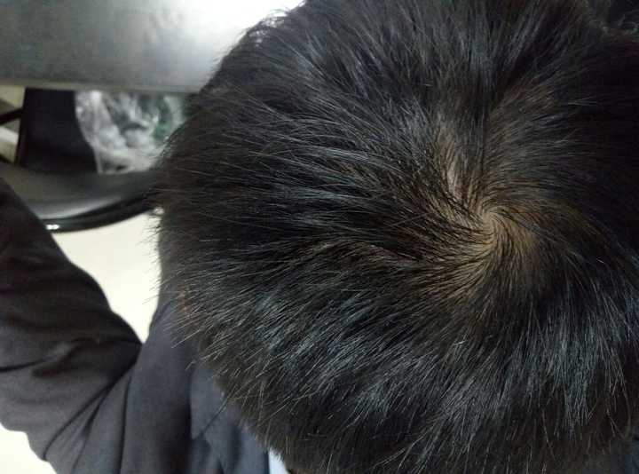 毛囊炎原来肿的地方掉了一块儿头发还能长出来吗?