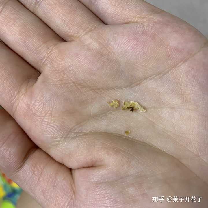 耳屎能大到什么程度