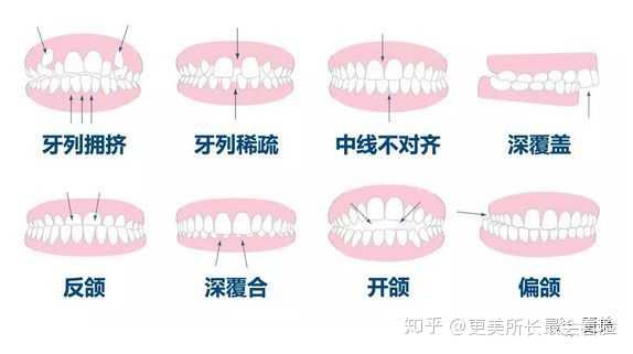 如果是 严重的牙列不齐建议 直接去看牙医哦