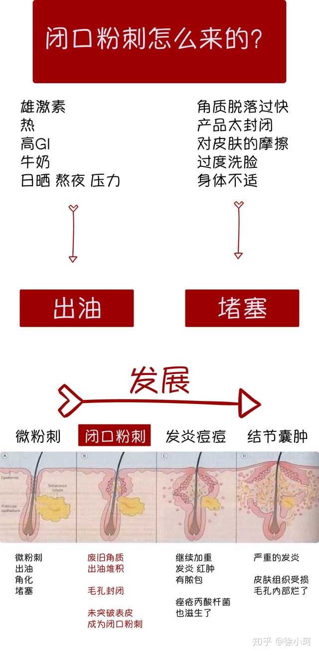 闭口粉刺,它是痘痘的一种,属于粉刺「低级别」.