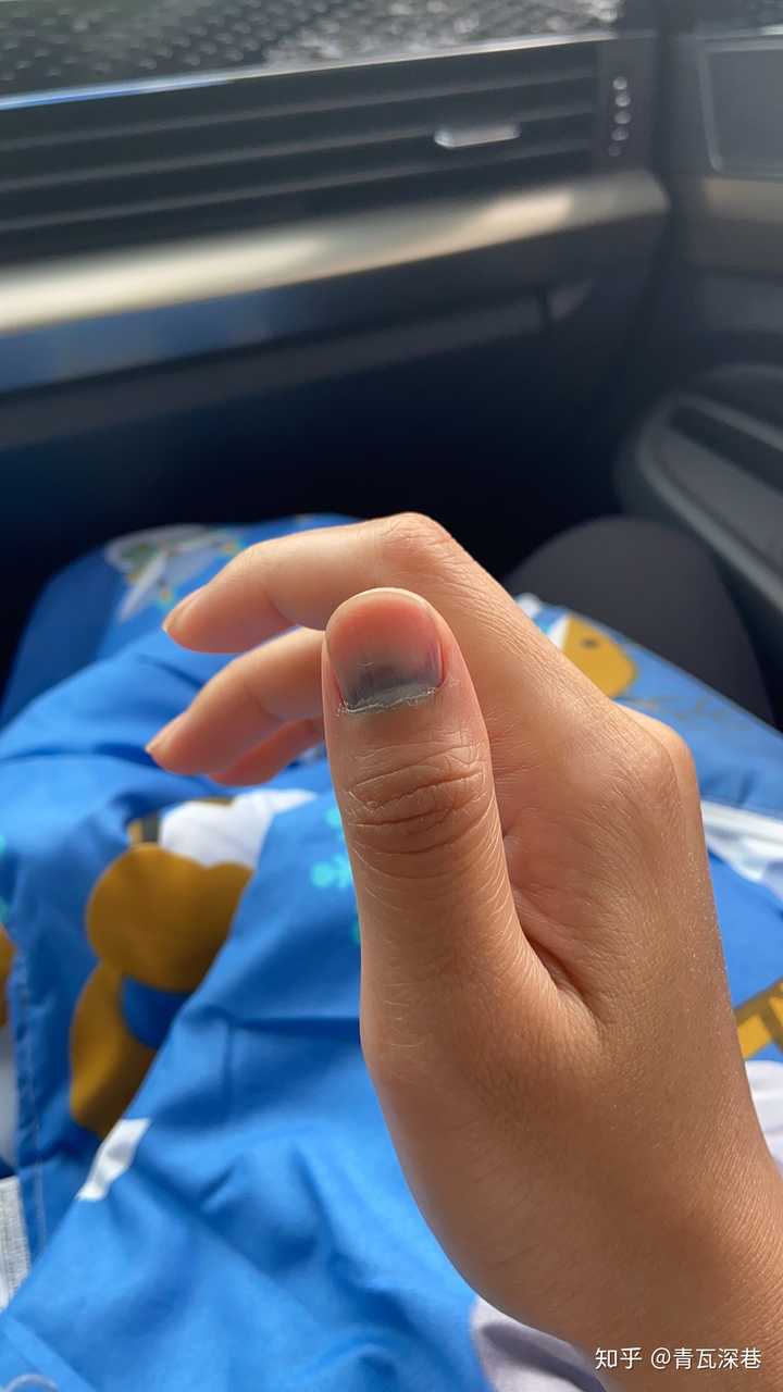 手被车门夹了怎么办?