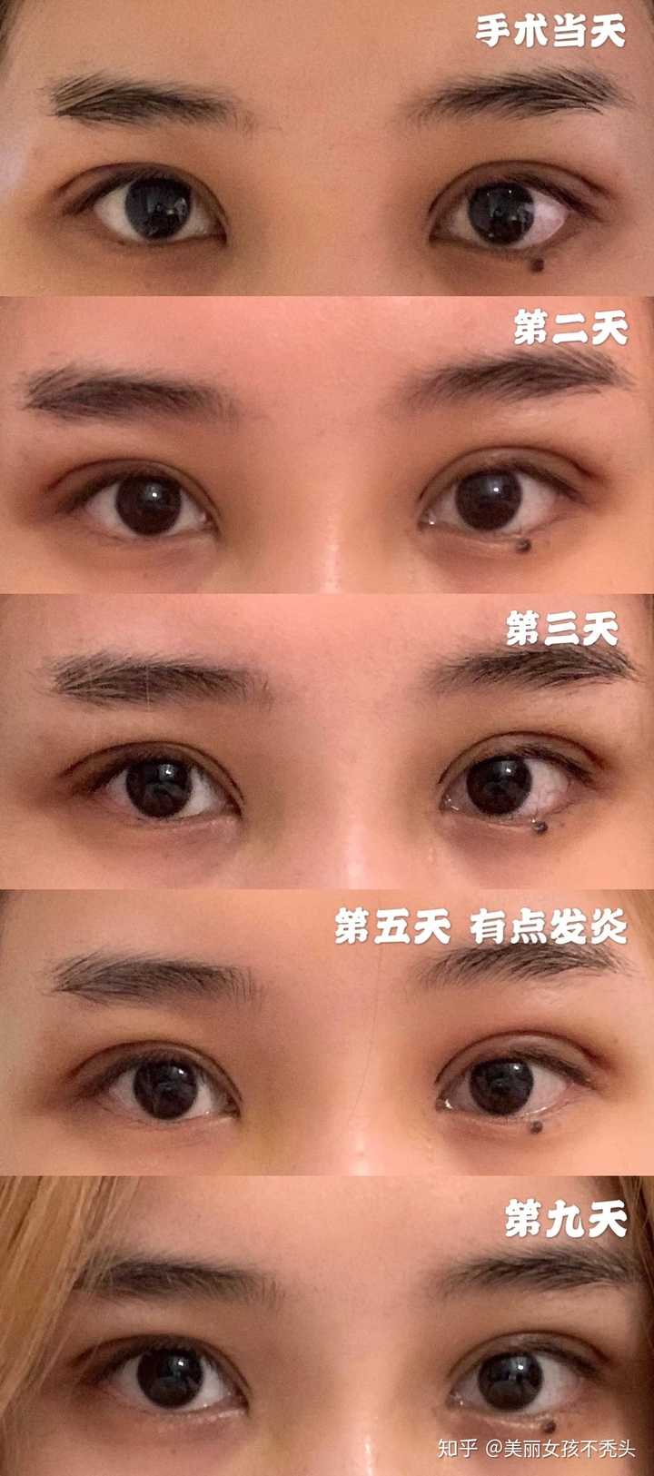 割双眼皮是真的割一条缝吗?