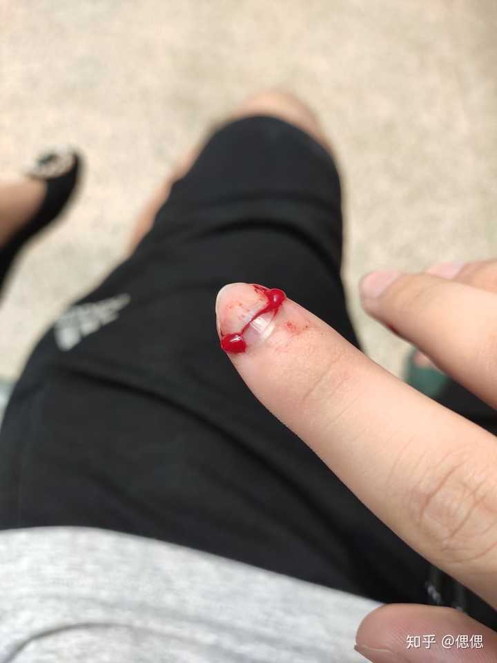 手指被门夹到飙泪是种怎样的体验?