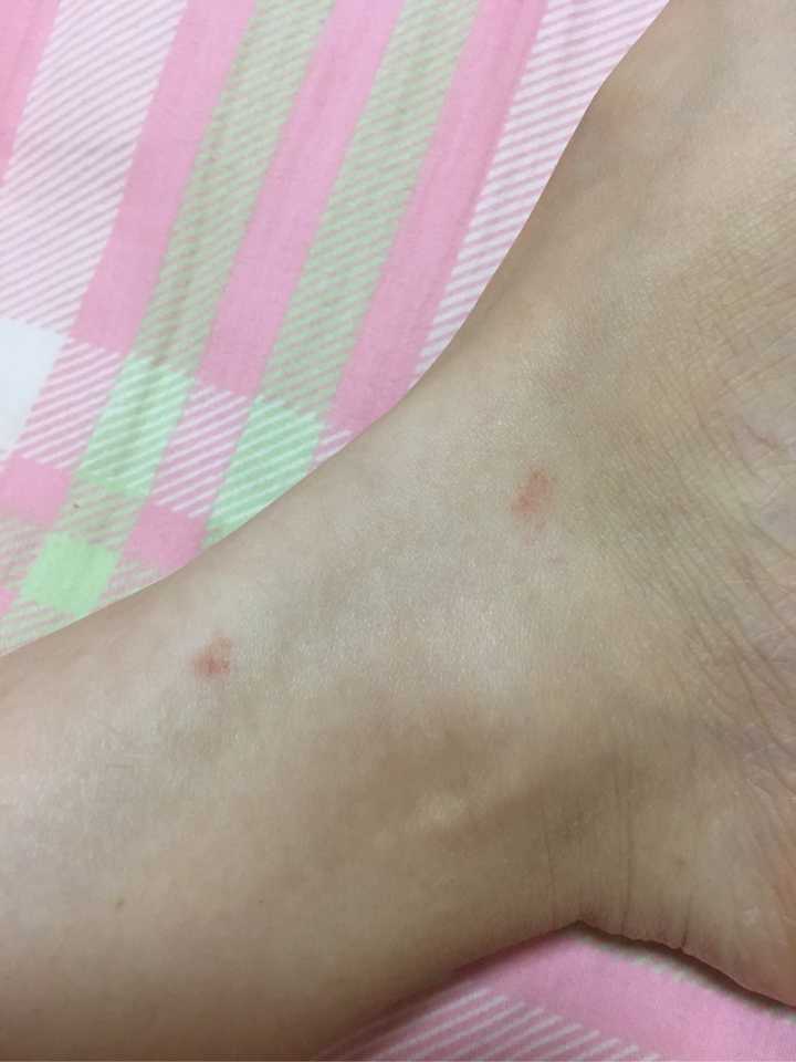 昨天朋友圈确认了是跳蚤咬的无疑了!