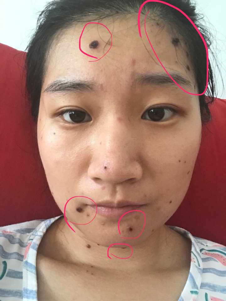 长水痘是一种怎么样的体验?