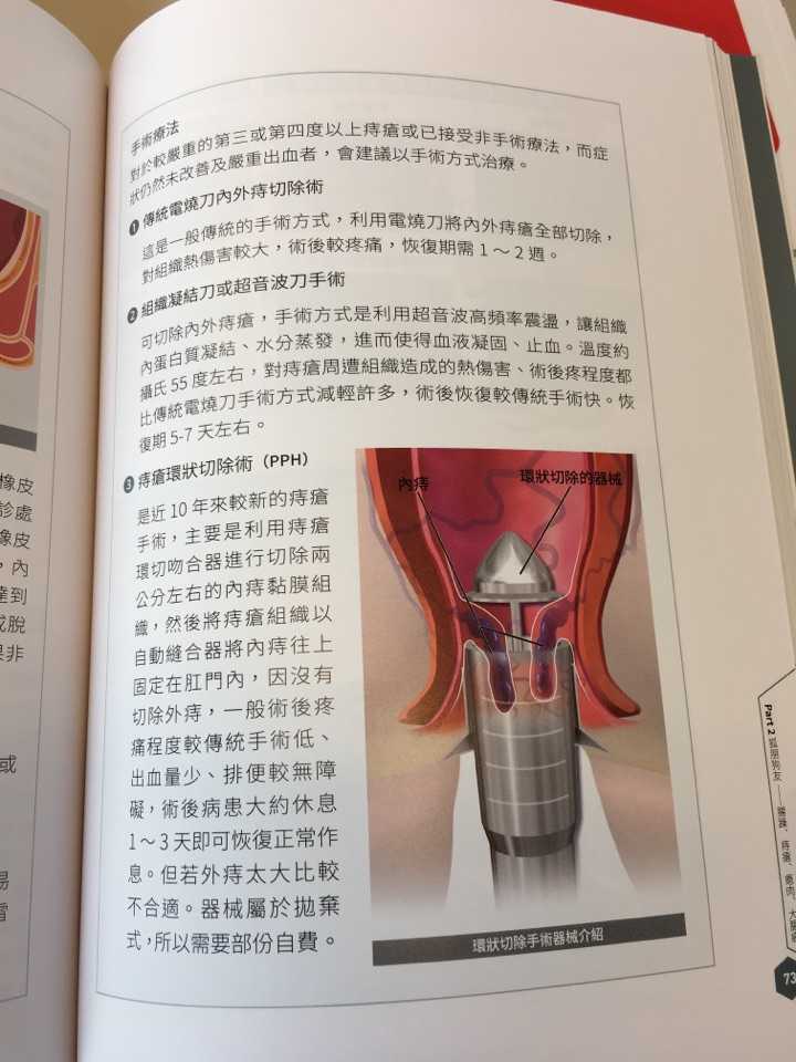 痔疮不手术,能自愈吗?