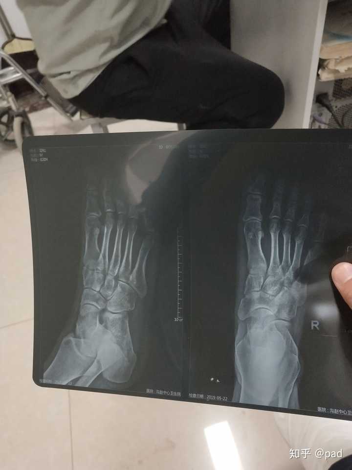 右脚第三第四远节骨骨折能评伤残吗?