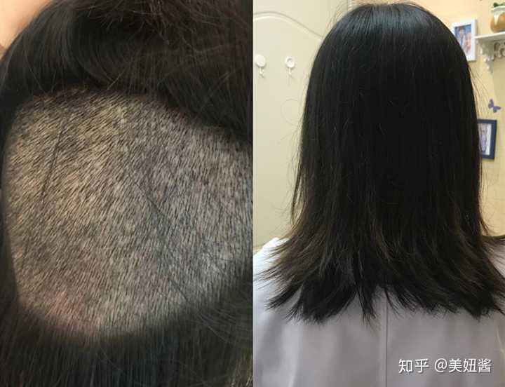 很多后脑勺头发少的妹子还是选择fue. 虽然贵,要剃一部分头.