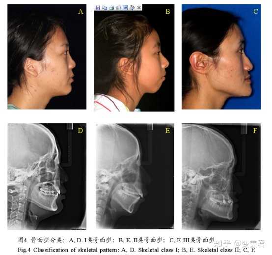 其实下巴是不会萎缩的,只是你的整个下颌骨往后退了一步.