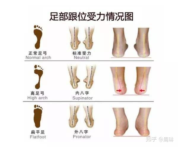 后天踝关节变形,和错误走姿,直接影响足弓类型,也会影响脚趾健康.