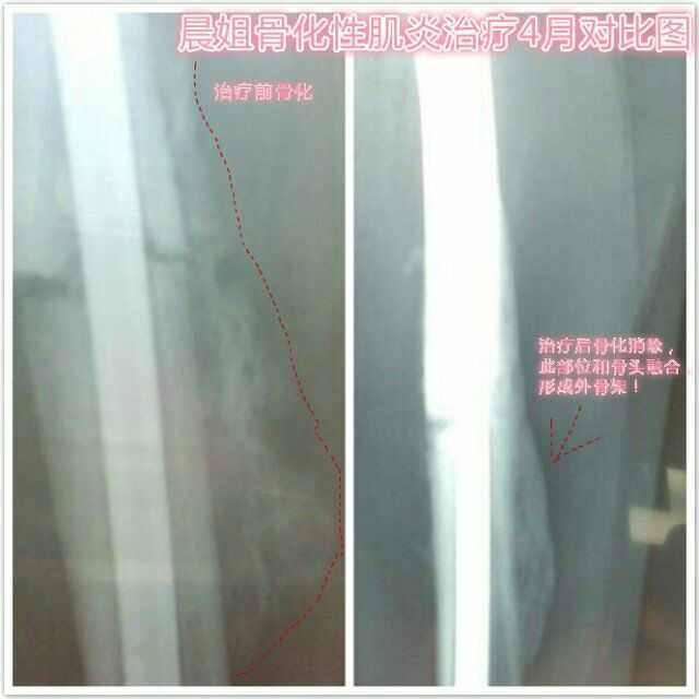 云南中医馆手术疤痕,骨折,骨化性肌炎部分患者治疗图