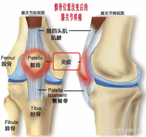 15岁双膝髌骨软化症 软骨磨损 髌腱炎 什么水平 我打篮球 有什么需要