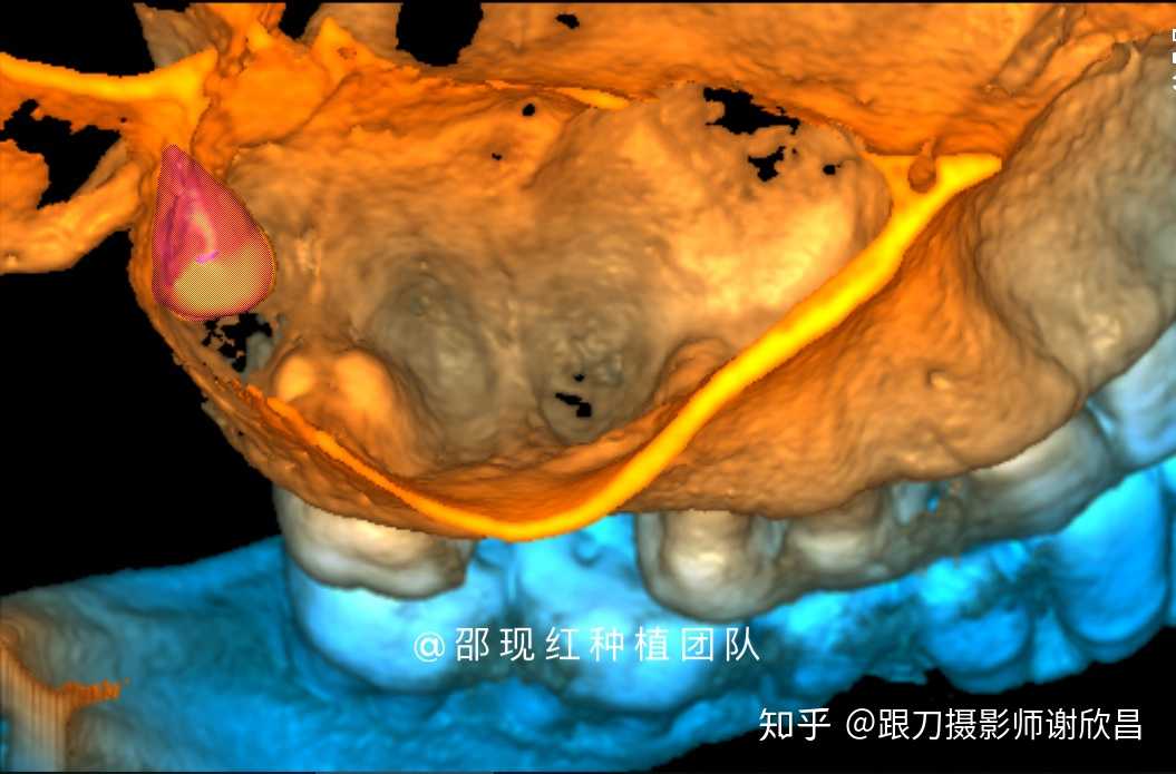 上颌窦黏膜破了咋办?