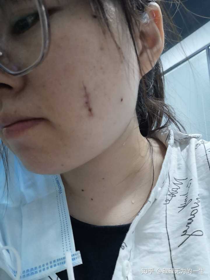 手术取痣要多少钱?取完后怎么护理?