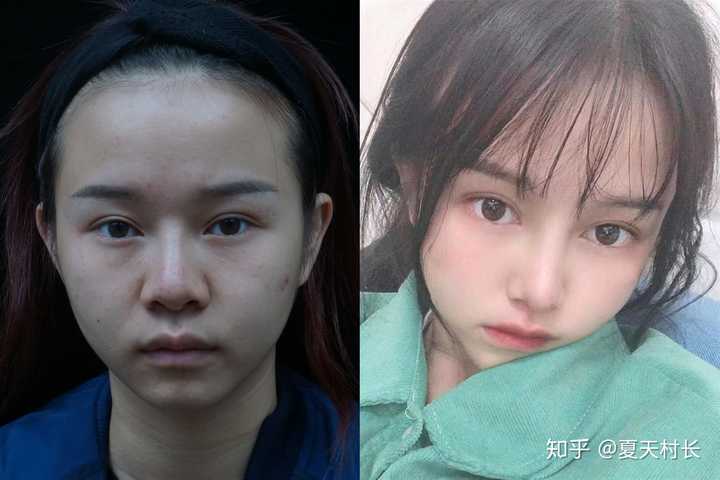 小姐姐鼻部基础鼻翼比较宽大,个人比较喜欢自然风格的鼻子 手术方案