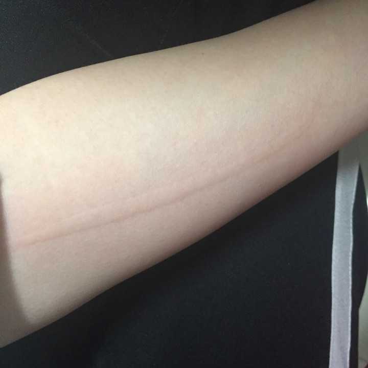 人工荨麻疹(皮肤划痕症)的原理是什么?有治疗的必要么