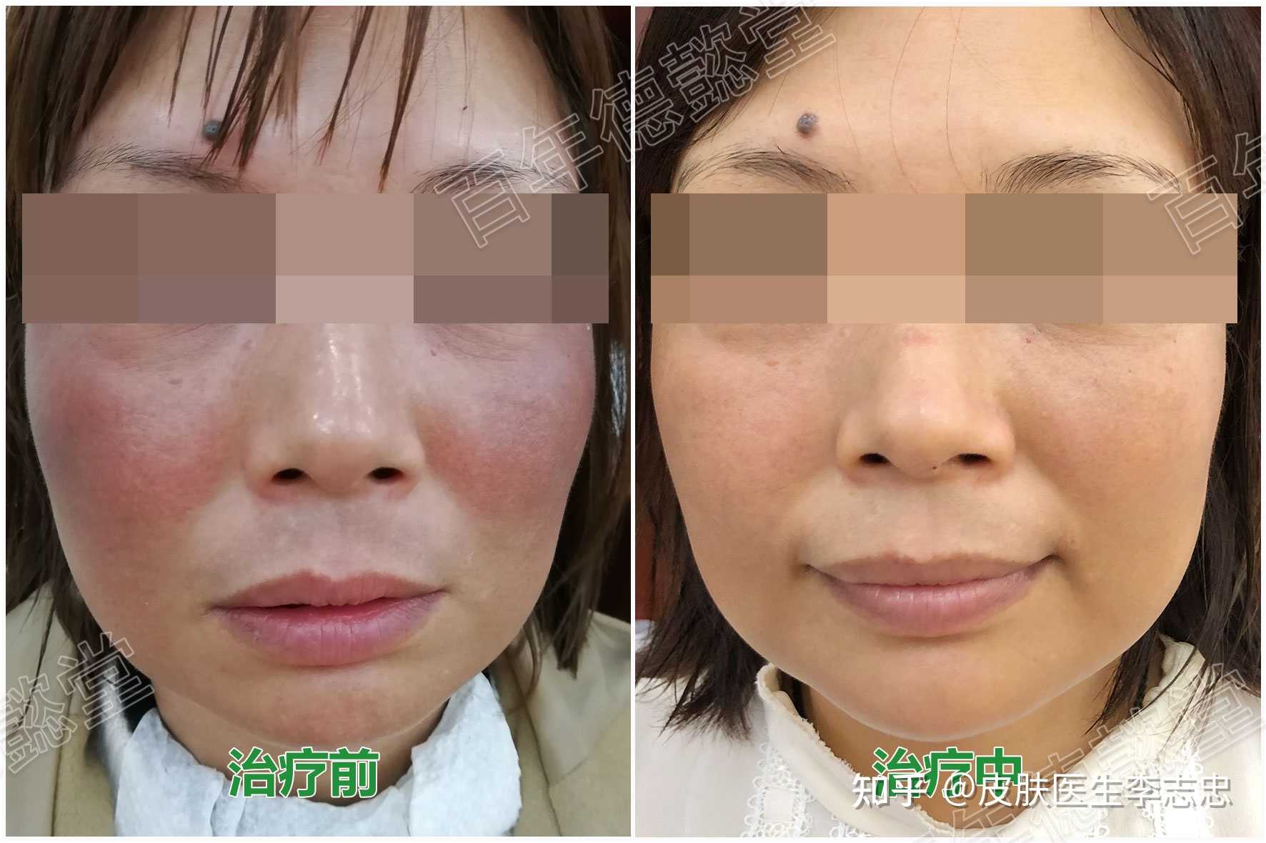 皮肤医生李志忠 的想法: 瑞尔氏黑变病,面色黑青,平时