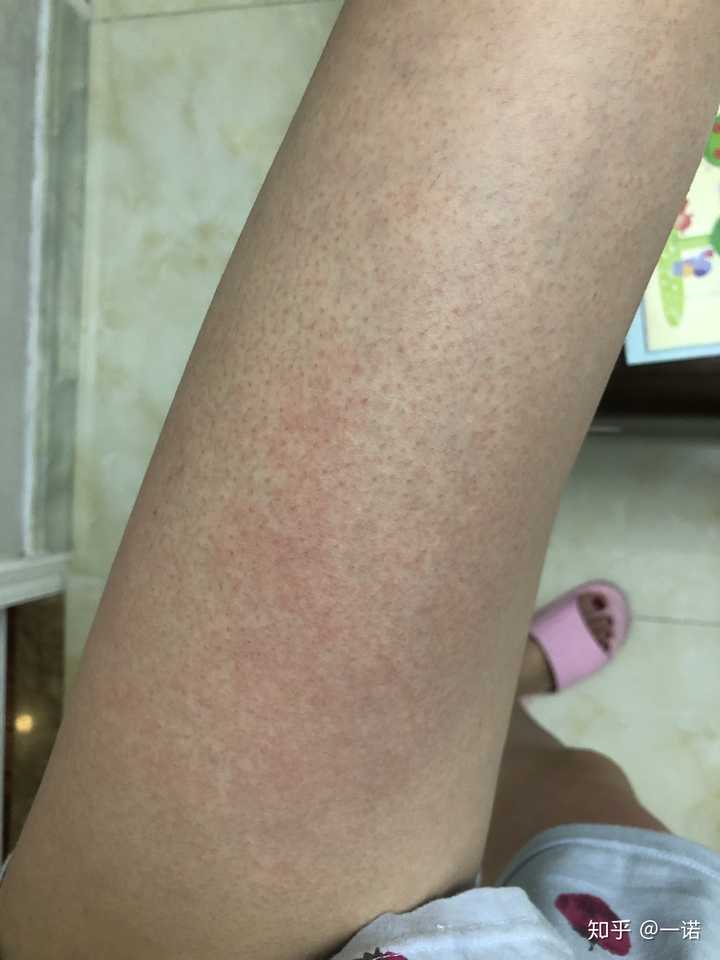 酒精过敏的人喝多了会怎么样