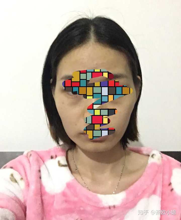 只是轻微有些下颌突出,她的问题在于左右脸不对称,和下颌和颧骨突出