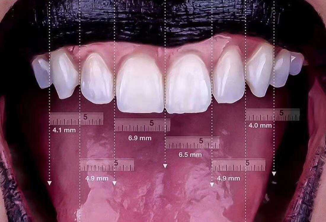 其实很多人都是这种情况,牙齿对应唇面宽度与长度都不一样,甚至颜色也